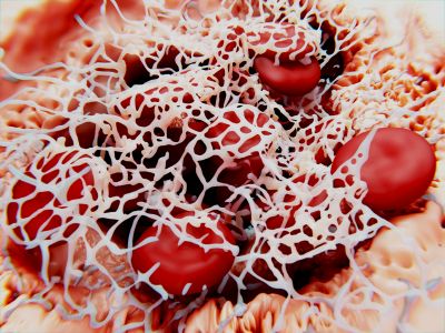 stable white Thrombus